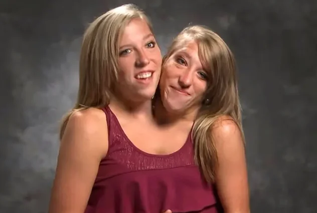 Abby Et Brittany Hensel Enceinte